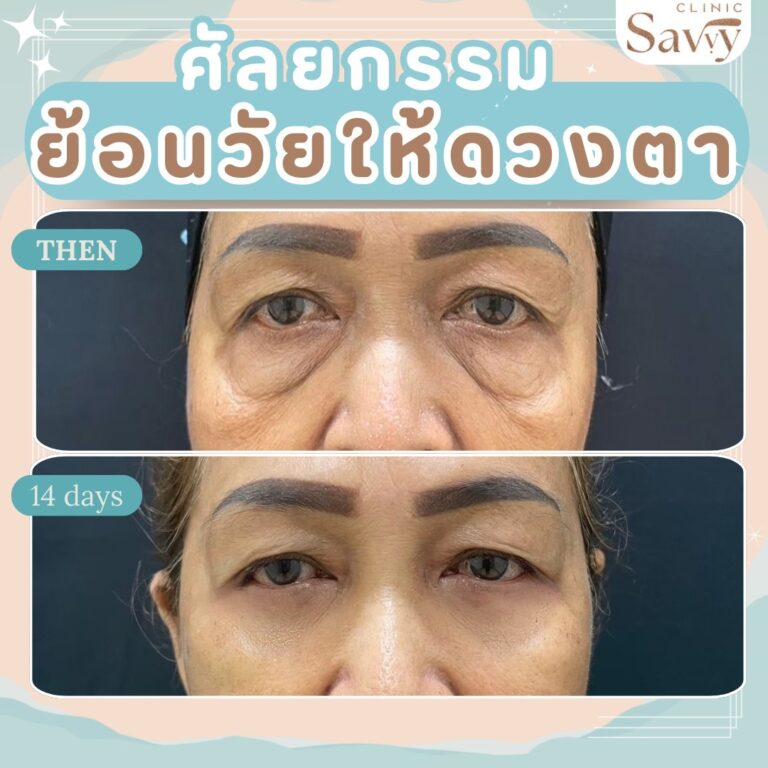 รีวิวตัดถุงใต้ตา แซฟวี่คลินิก