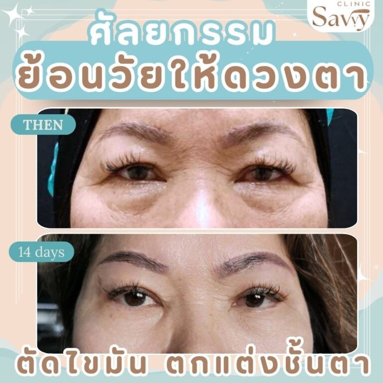 ศัลยกรรมSubbrow Lift แซฟวี่ คลินิก