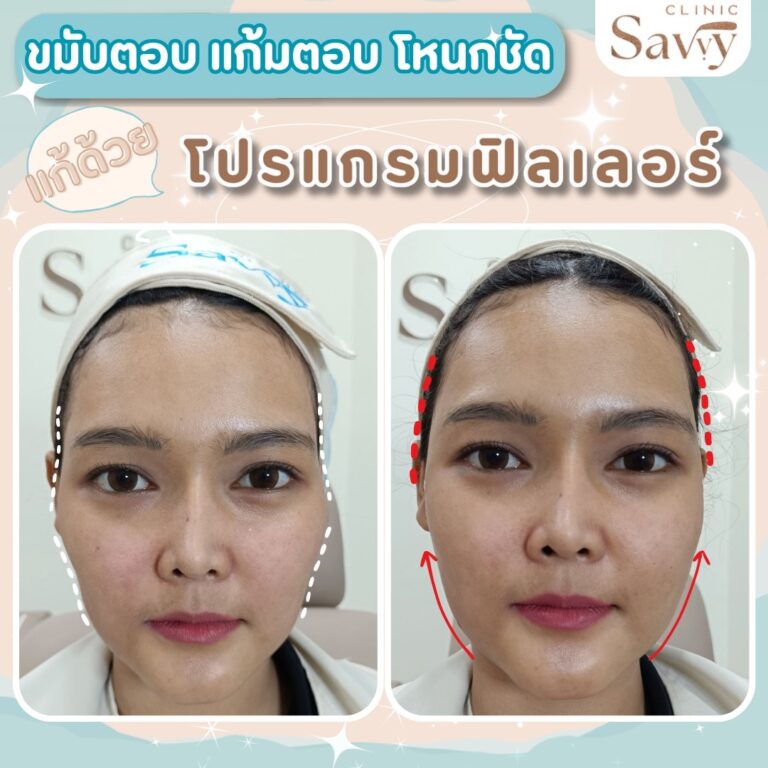 รีวิว โปรแกรมฟิลเลอร์ แซฟวี่คลินิก