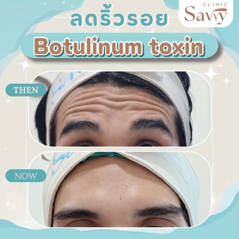 รีวิวโปรแกรมยกฉีดBotox แซฟวี่คลินิก