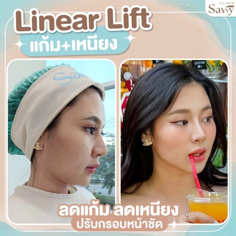 รีวิวโปรแกรมยกกระชับLinearLift แซฟวี่คลินิก