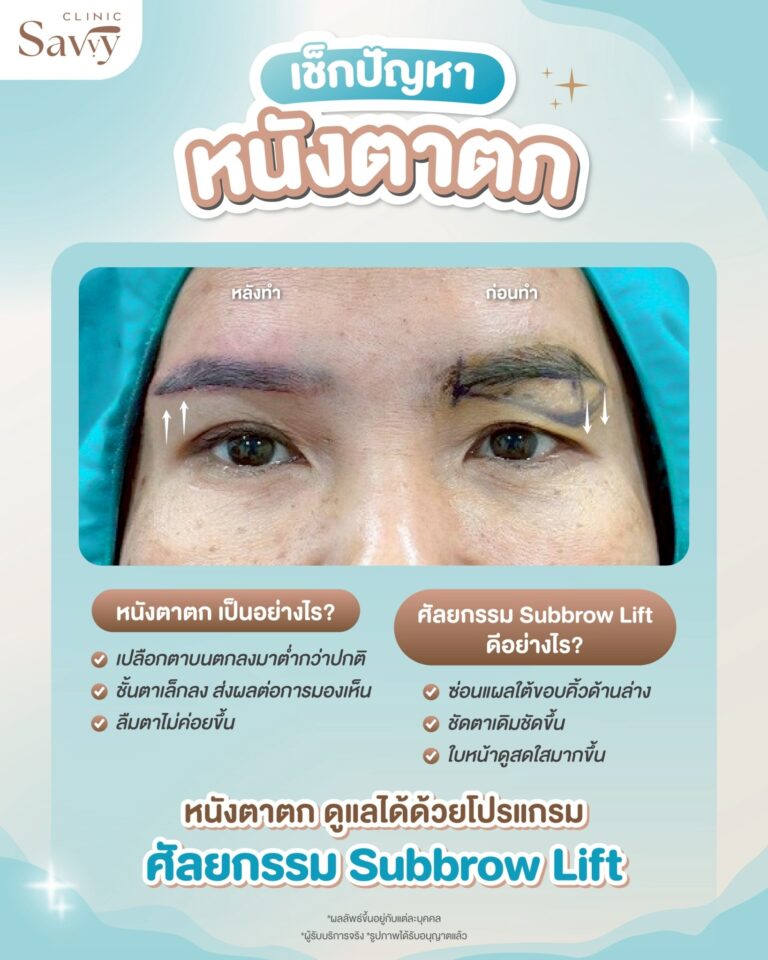 Subbrow Lift Savvy Clinic ศัลยกรรม ลาดกระบัง ประเวศ