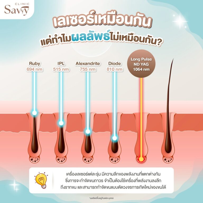 เลเซอร์ขน Long Pulse ND Yag - Savvy Clinic