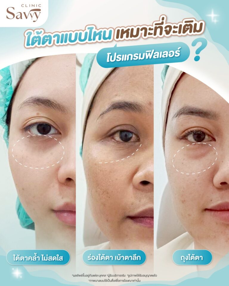 ใต้ตาแบบไหนเหมาะเติมฟิลเลอร์ Savvy Clinic